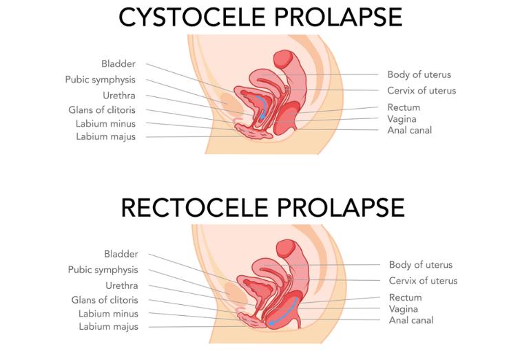 Anterior and posterior repair