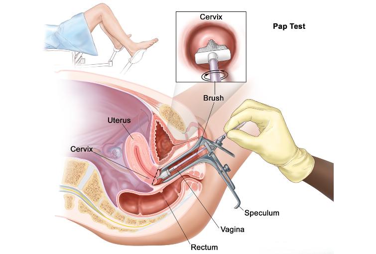 Cervical Cancer Screening (Pap Smear)