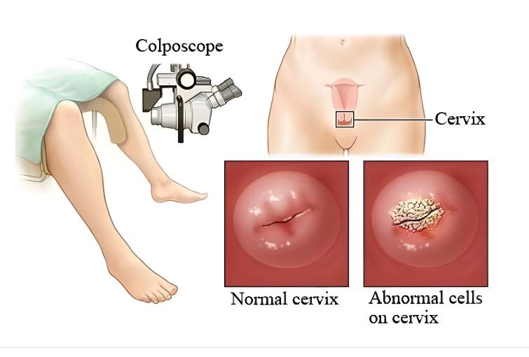 Colposcopy & HPV Assessment