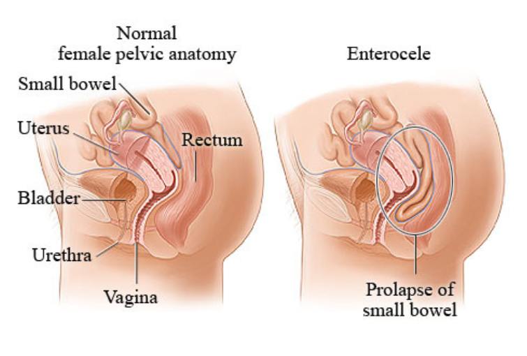 Enterocele repair