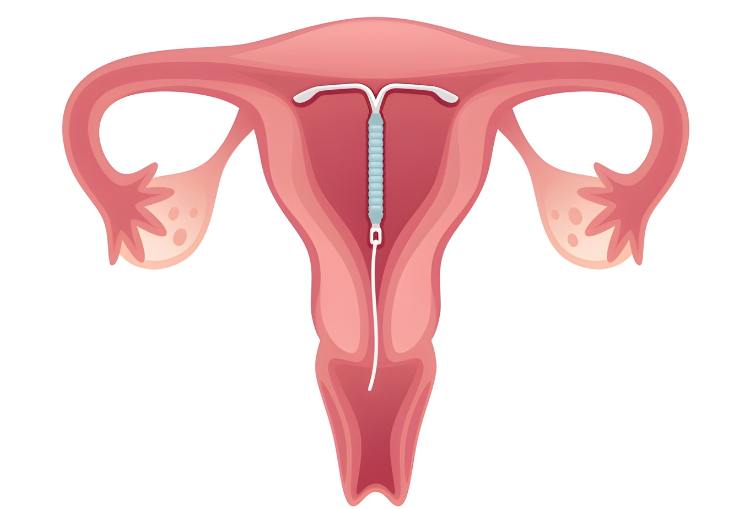 IUD (Insertion & Removal)