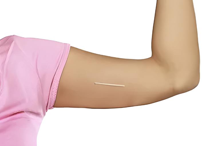 Implanon (Insertion & Removal)