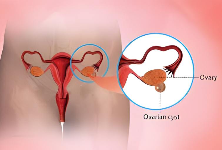 Ovarian Cyst Treatment