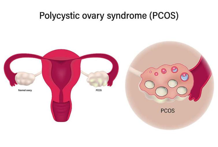 PCOS Management