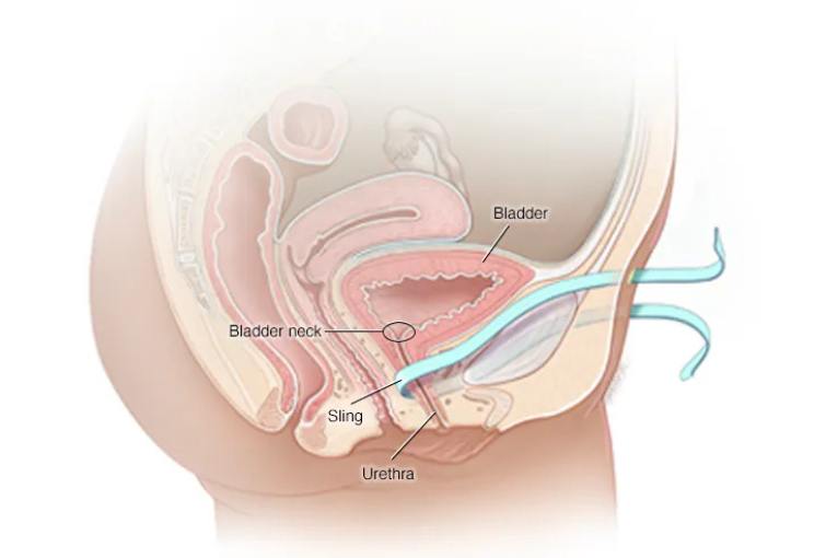Incontinence procedure