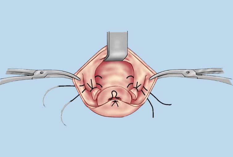 Uterus preserving surgery